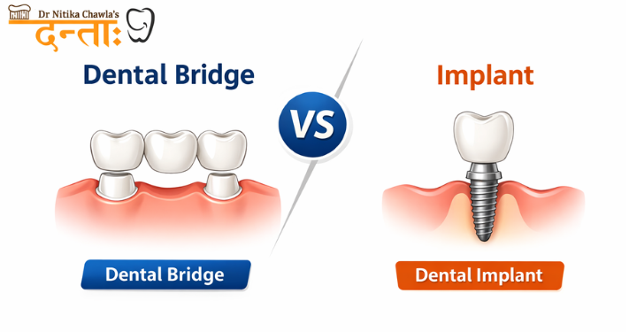 dental bridge vs implant
