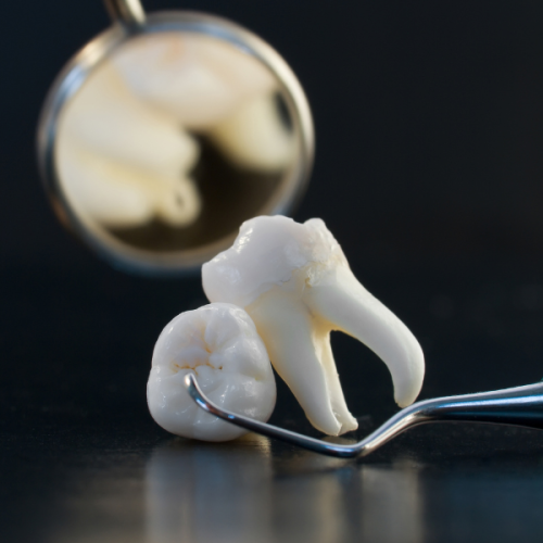 wisdom-teeth